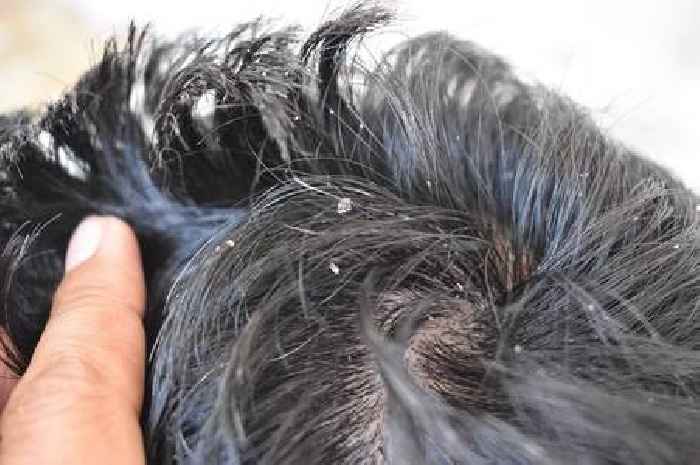 Common winter hair problem can be treated with four ingredients say NHS