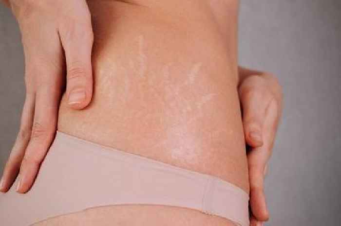 'I'm a skin doctor – there are three ways you could banish your stretch marks'