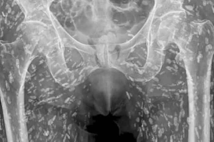 Disgusting x-ray shows shocking 'zombie' tapeworm infection following kitchen blunder