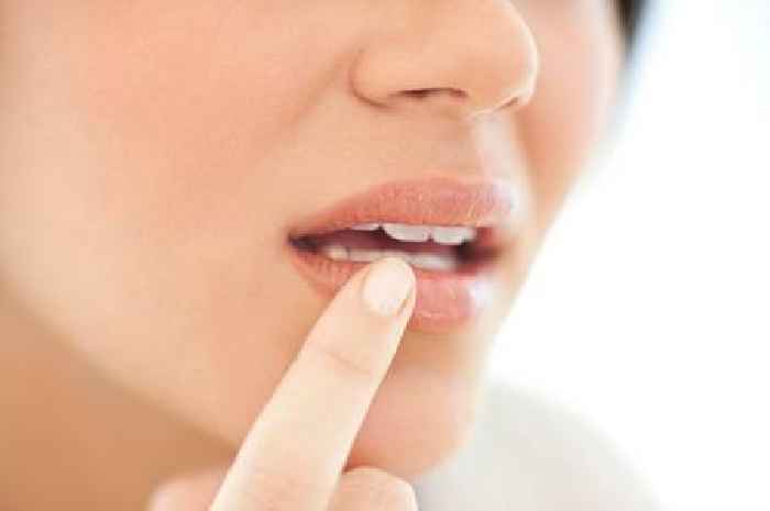 Pharmacist says there are three instances you should seek medical advice about cold sores