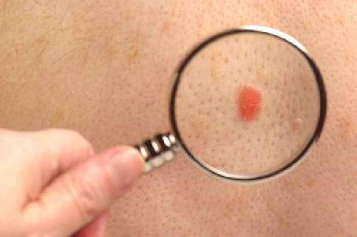 Cosmetic surgeon shares three early signs of skin cancer – and when to worry