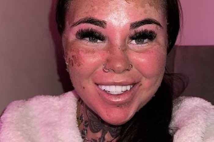 Woman warns about dangerous sunbed trick after burning skin off face