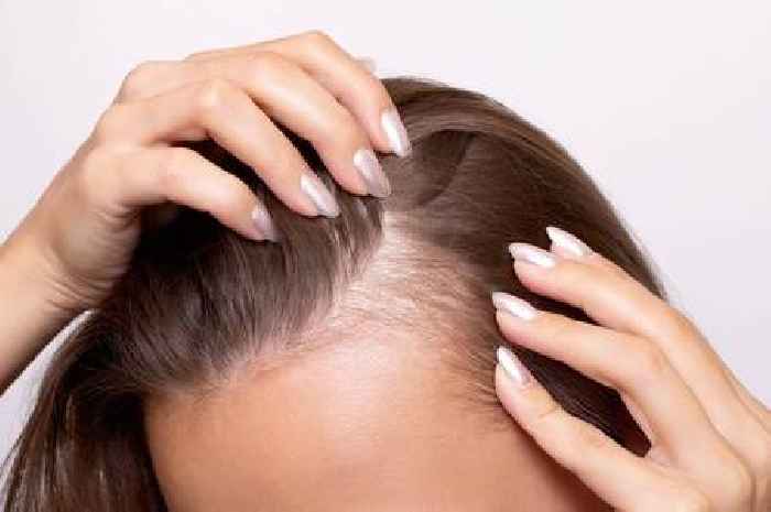 Three foods doctor says can 'promote hair growth' and 'combat thinning'