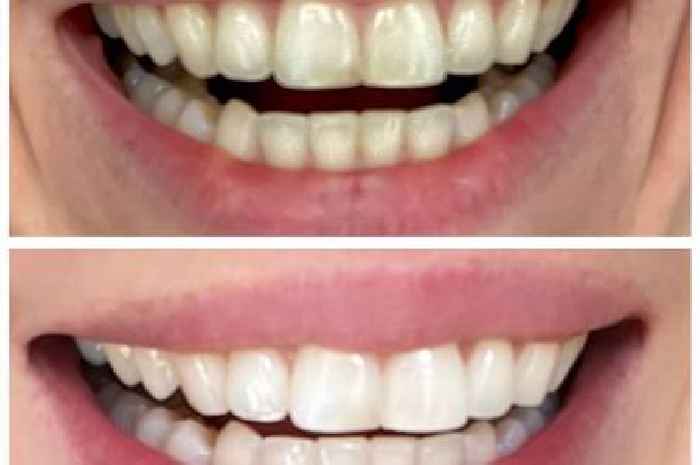 Shoppers say £16 teeth whitening pen is a 'must-have' for 'visibly whiter' smile