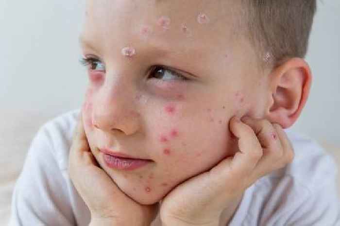 NHS informs parents of highly infectious virus that 'mostly affects children'