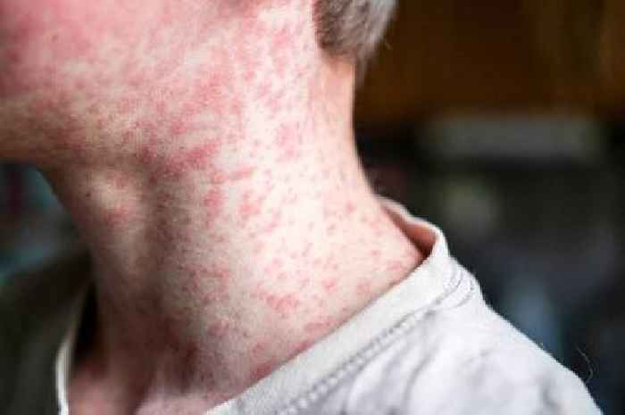 Highly contagious virus outbreak alert issued for 57 countries after explosion in cases