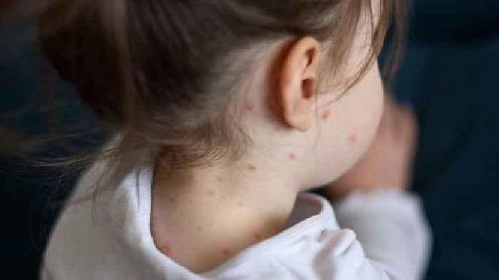 Unvaccinated child dies from measles in first US death from virus since 2015