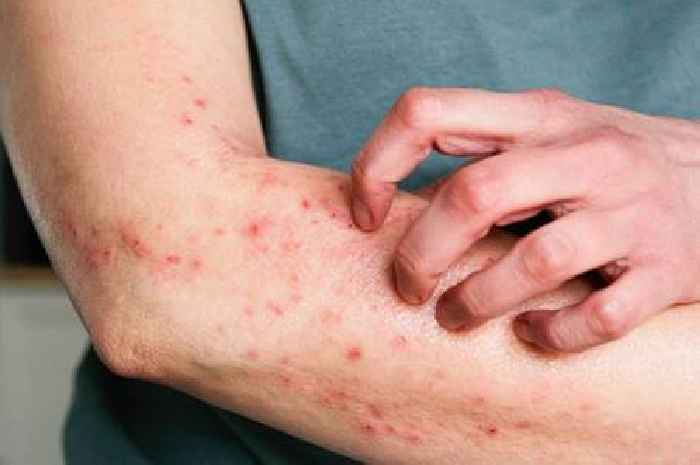 NHS issues call 111 warning if skin condition leads to two new symptoms