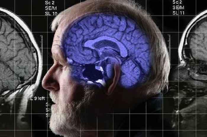 Alzheimer's risk 'reduced by 53%' if people follow one diet that helps disease