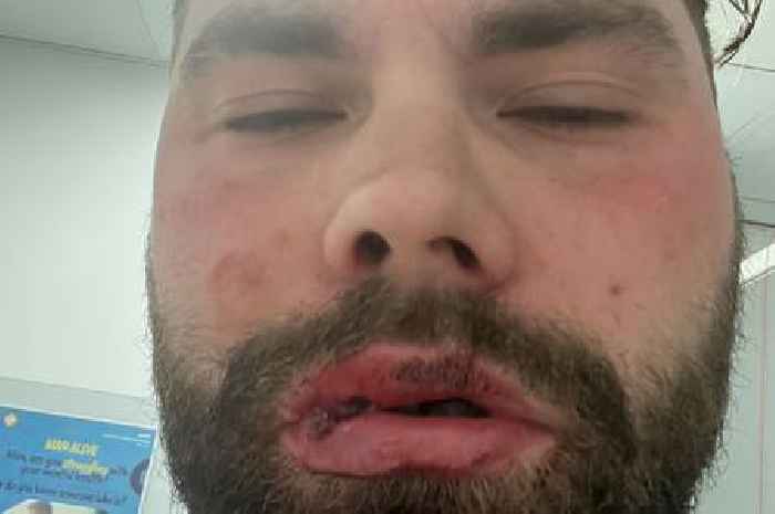 Man left with nine shattered teeth after being shot with catapult