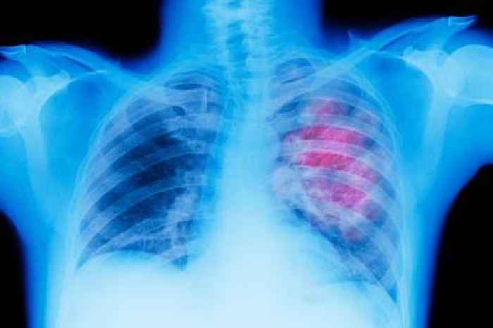 Lung cancer risk linked to surprising lifestyle choice - it goes beyond just smoking