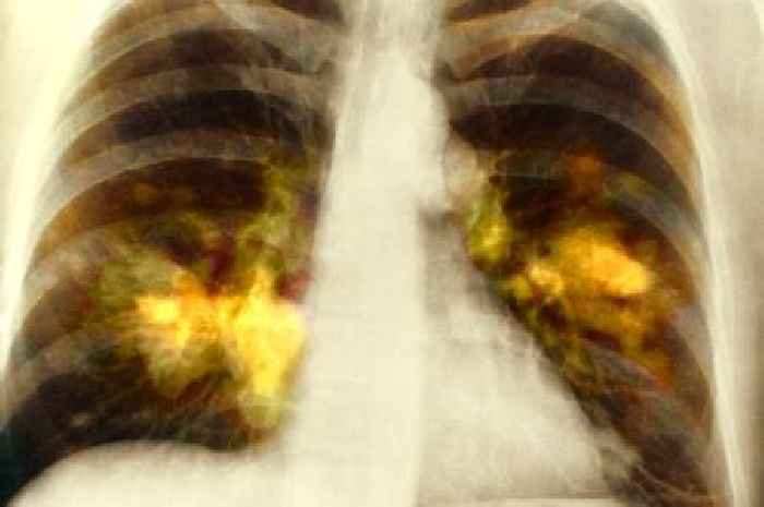 One thing is a 'giant lollipop' for lung cancer's 'sweet tooth' scientists warn