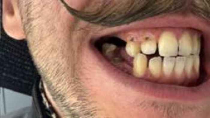 Man with dentist phobia sees teeth 'crumble away'