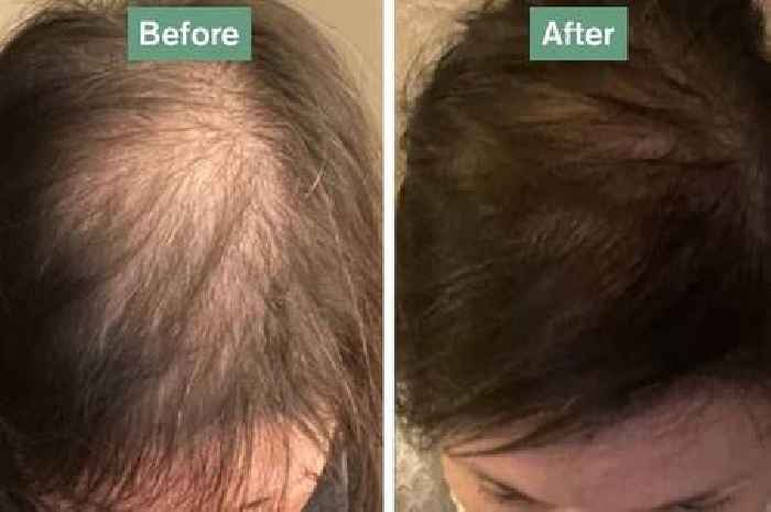 Shoppers 'losing hair' notice 'incredible amount of growth' within weeks using tablets