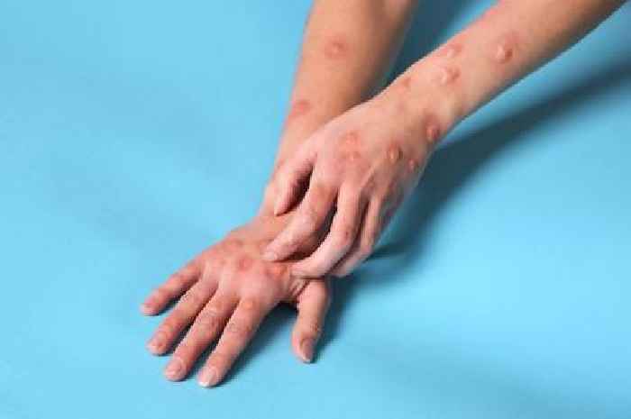 UKHSA investigation after patient found to have Clade Ib mpox with no links to confirmed cases
