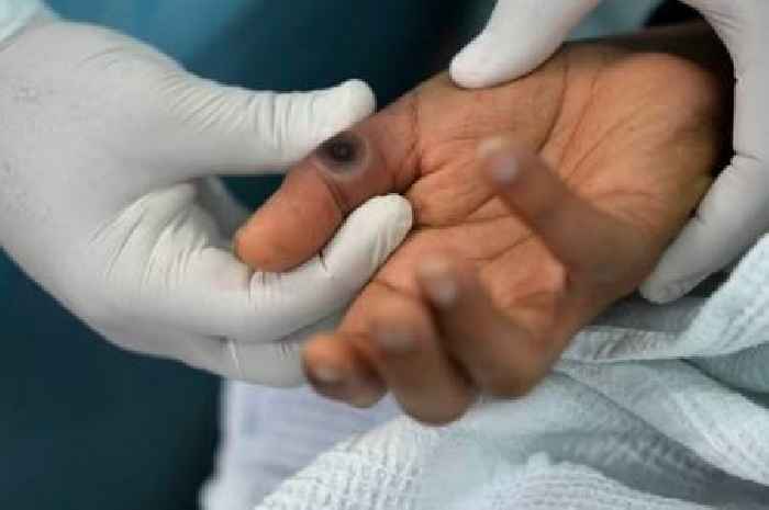 UKHSA update on 'severe' mpox after new case detected in UK