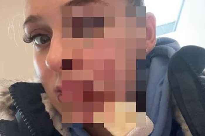 'My face was left looking like a Halloween mask after 62stone cow jumped on my head'