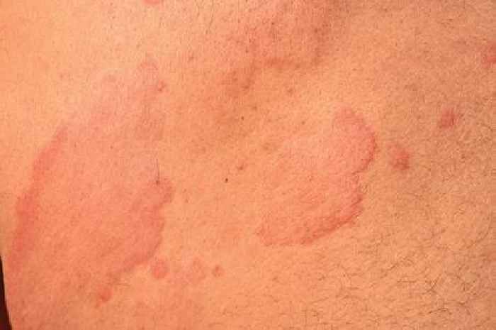 Doctor shares what you should do if you get mysterious 'itchy' rash on your skin