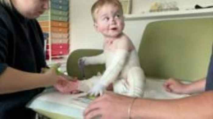 Watch: Life raising a toddler with 'butterfly skin'