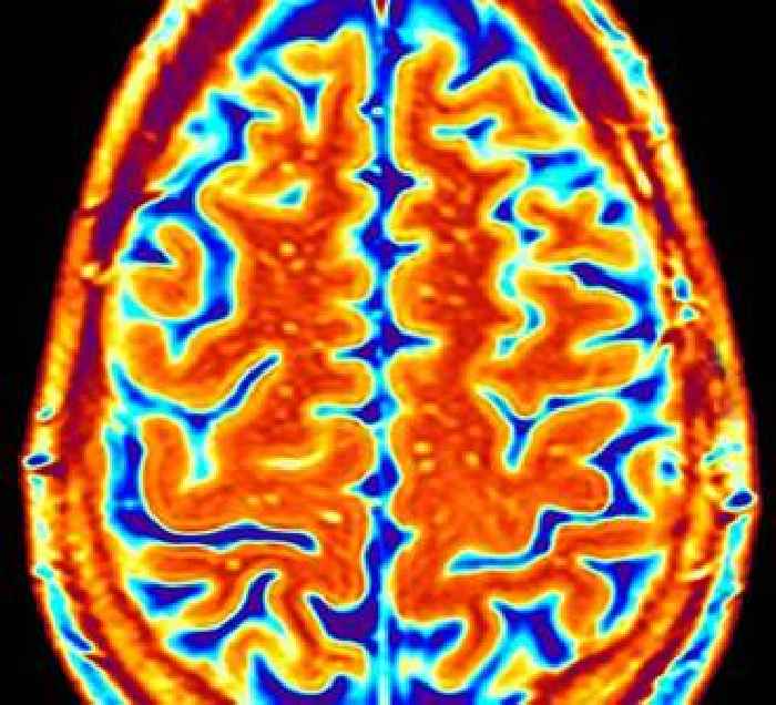Heart problem could be linked to accelerated ageing and 'cognitive decline'