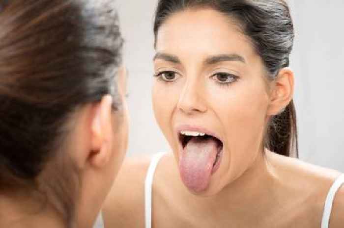 Doctor explains white coating on your tongue - and what it says about your health