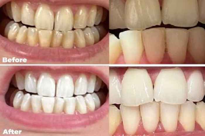 Shoppers with 'years of coffee stains' make teeth 'several shades whiter' using 90p strips