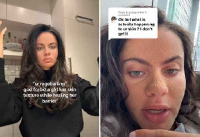 Girl Trying ‘Caveman Skincare Routine’ Gets Fungal Infection on Face