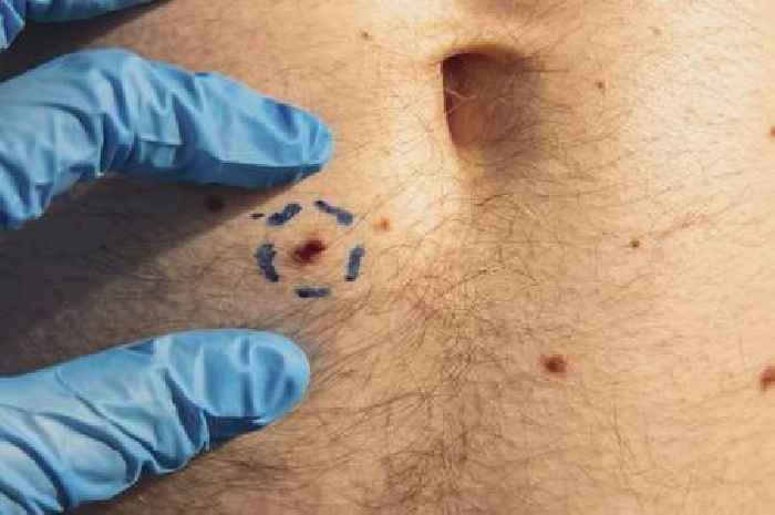 Consultant dermatologist explains skin spot 'rule' and when to see doctor