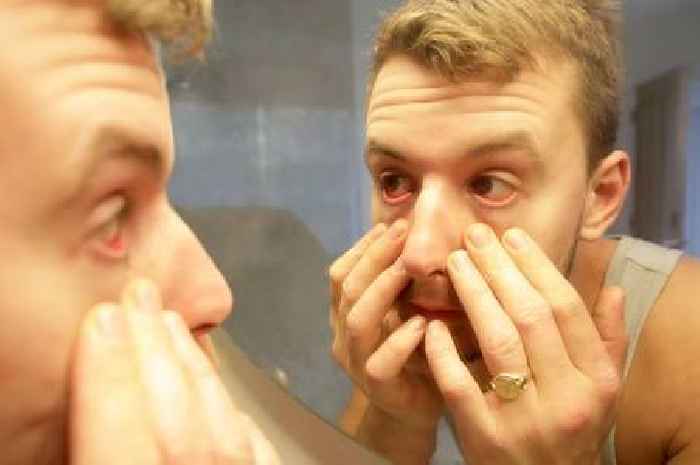 Little-known symptoms of measles you may mistake for hay fever