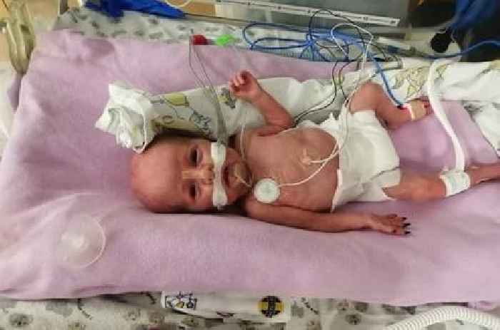 News24 | Joburg mom's shock as premature son loses his fingertips