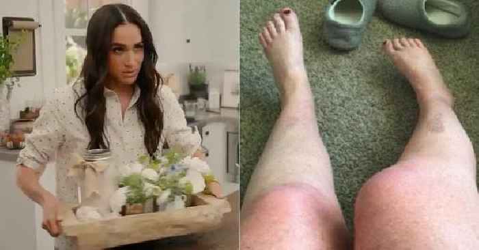 Meghan Markle Threatened With $10 Million Lawsuit After Fan Suffers 'Catastrophic Burns' From Duchess' DIY Bath Salts: Shocking Photos