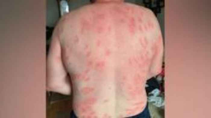 Man with 250 wasp stings afraid to ride his motorbike