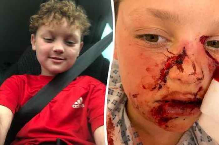 'Staffordshire Bull Terrier' attack leaves boy, 8, looking like this