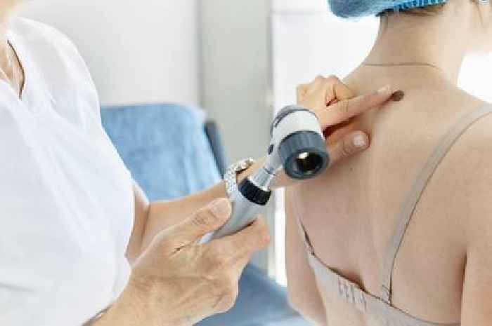 Doctor who survived cancer shares melanoma warning over 'strange' moles
