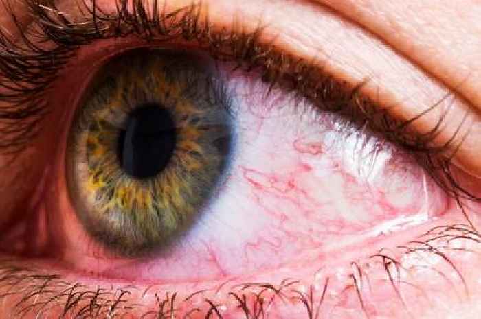 How to tackle itchy eyes when you have hay fever - including one thing people never think about