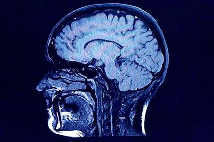 Three types of dementia 'linked to genetics' - including rare type of Alzheimer's