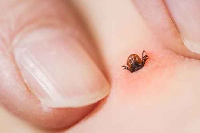 Doctor shares exactly what to do if you get bitten by a tick this summer