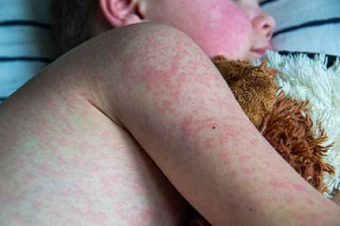 Measles cases soar in Scotland as health chiefs issue vaccination plea