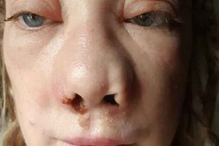 Mum in 'worst pain of life' after botched Turkey teeth saw face collapse