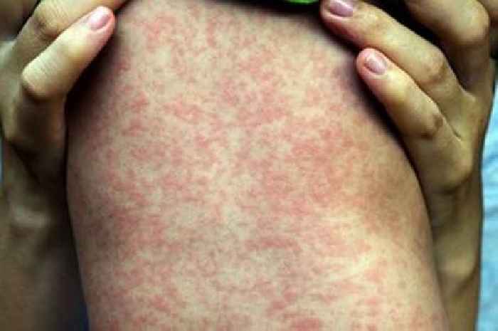 Birmingham measles ‘wave’ warning amid 'large gatherings' alert