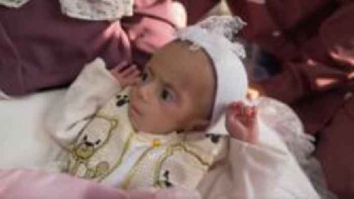 A frail cry and relief: Malnourished baby Siwar evacuated from Gaza