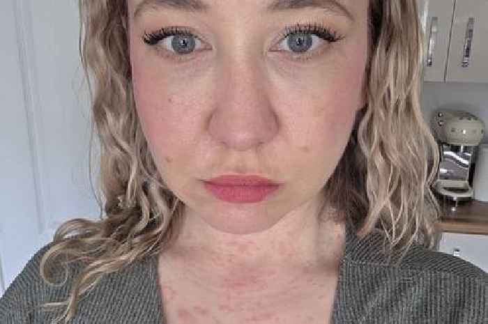 Mum left 'ravaged' by 'hot tub rash' after birthday trip to Wales