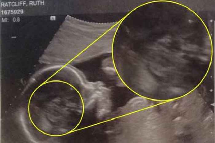 Mum-to-be sees face of dead nan staring back at her in baby scan