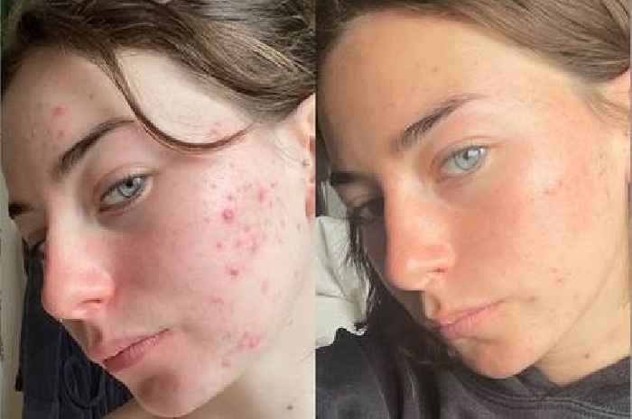 Non-greasy SPF that's 'anti-blemish' gives clearer skin and 'more confidence'