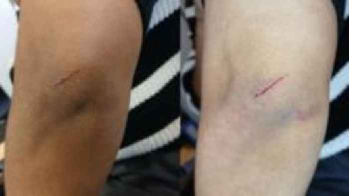 Met uses new tech to record bruising on dark skin