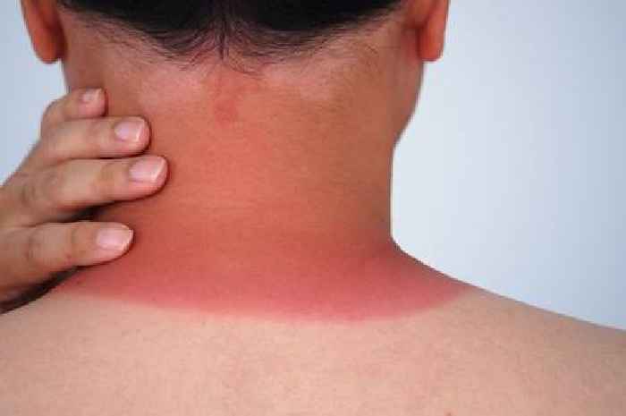 Physiologist says 'never' when treating sunburn as it can make it worse