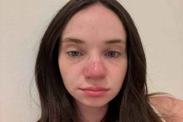 Woman left with permanent sunburned red nose after falling asleep on holiday