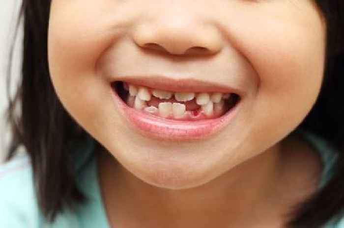Almost two-thirds of five-year-olds in one Leicester area have tooth decay
