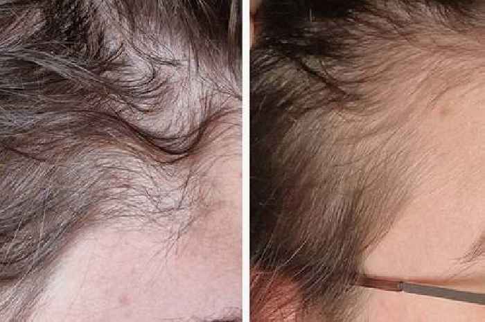Woman shares hair transformation using supplements that cost her 49p a day