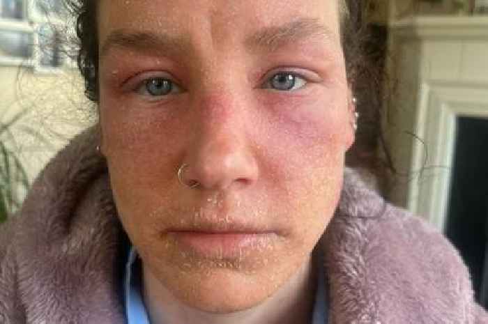 Woman's 'small rash' turns into years of 'hell' after extreme reaction